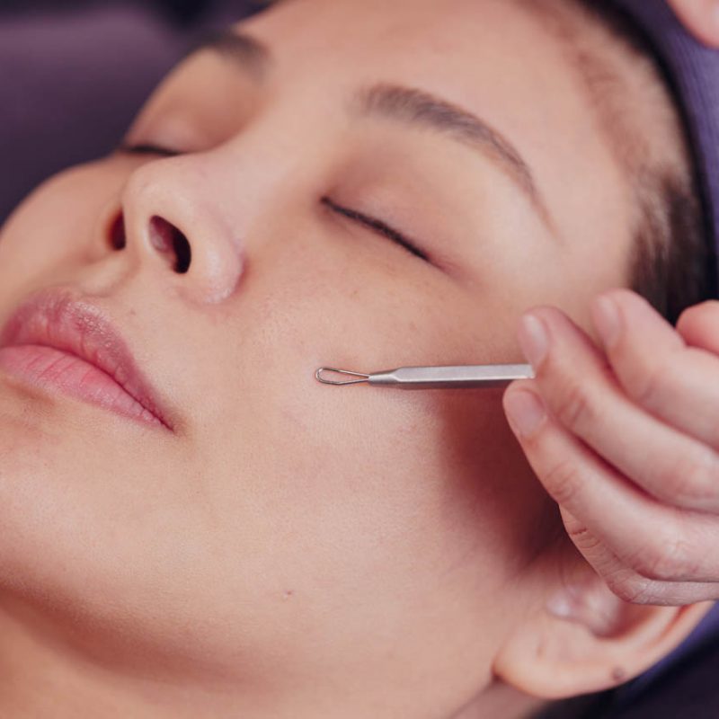 Acne Express Defence Facial