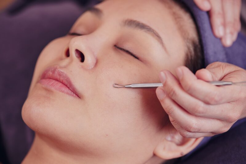 Blackhead Extraction
